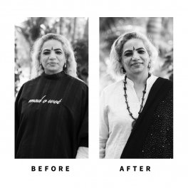 Baldihappy-BeforeAfter-Donors-04