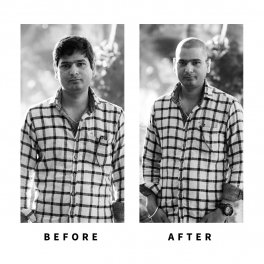 Baldihappy-BeforeAfter-Donors-15
