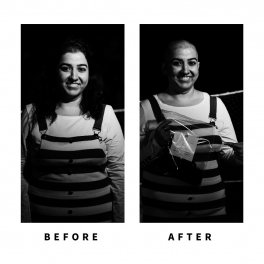 Baldihappy-BeforeAfter-Donors-29